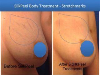 Breast Stretch Mark Spa Treatments