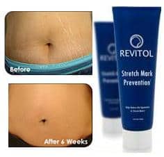 Revitol-Stretch-Mark-Solution before and after photo