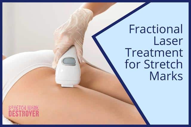 Fractional Laser Treatment for Stretch Marks