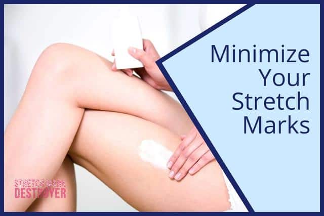 How to Minimize Stretch Marks on ANY Body Part