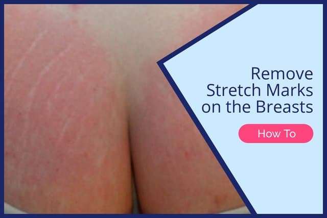 How to Get Rid of Stretch Marks on Breasts [FAST METHODS]